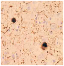 磷酸化α- 突触核蛋白抗体(pSyn#64)